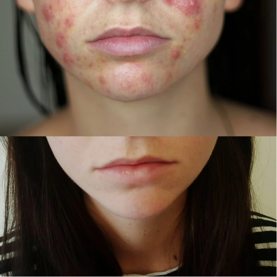 Blogger Alice Lang successfully cleared up her cystic acne after going on a drug known as spironolactone, which is commonly used to treat heart conditions. See her dramatic before-and-after photos here.