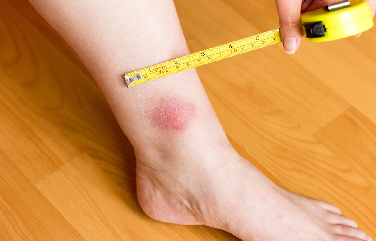 Single large horsefly bite on left leg above ankle with yellow measuring tape. (Alamy Stock Photo)
