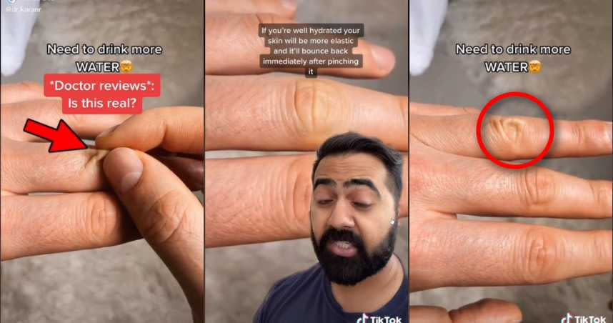 TikTok網友上傳影片，表示只要捏住手指的皮膚3至5秒後，如果皮膚像紅圈處那樣沒有馬上恢復原狀的話，就代表你已經脫水了，需要趕快補充水分。（圖／翻攝自TikTok）