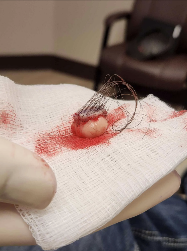 A gloved hand holds a medical gauze with a small, bloodied mass that has hair attached to it. The background shows part of a chair and an indistinct room