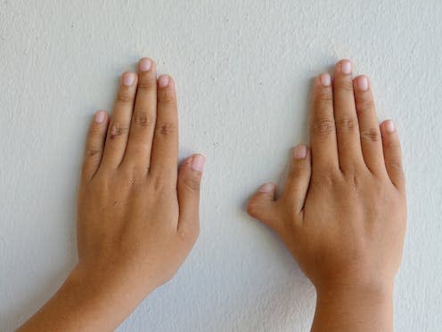 <span class="caption">Around 1% of the world's population are born with extra fingers or toes.</span> <span class="attribution"><a class="link " href="https://www.shutterstock.com/image-photo/photo-polydactyly-on-human-rare-abnormal-1281943645" rel="nofollow noopener" target="_blank" data-ylk="slk:Thiti Sukapan/ Shutterstock;elm:context_link;itc:0;sec:content-canvas">Thiti Sukapan/ Shutterstock</a></span>