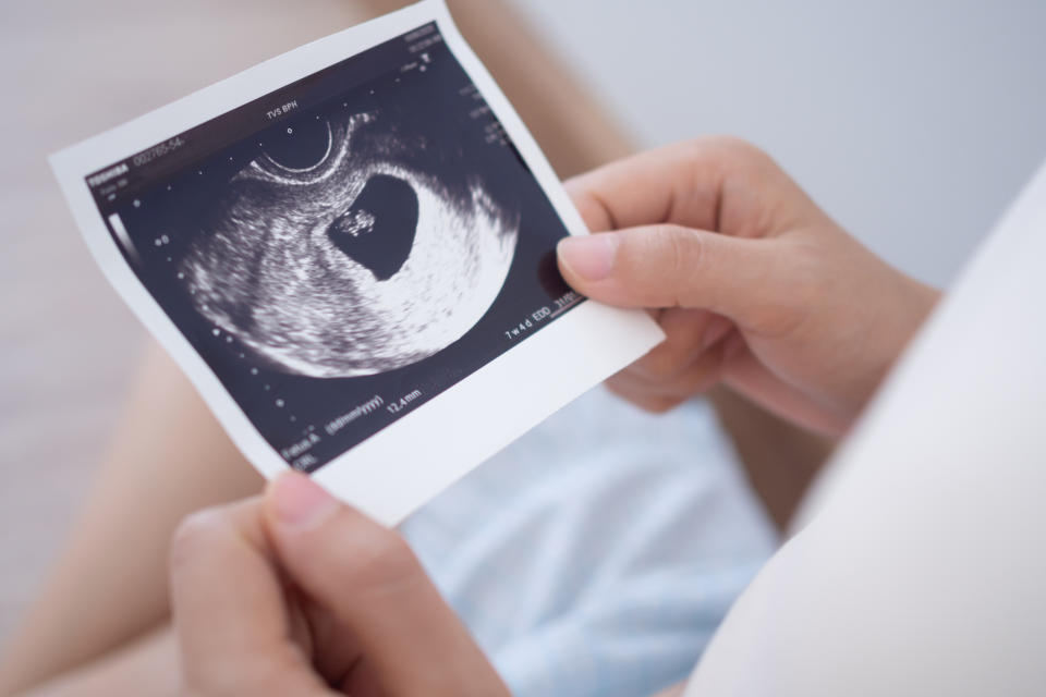 Hands holding an ultrasound with a visible fetus, related to pregnancy and love