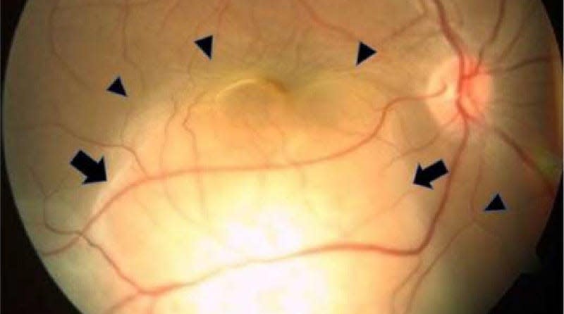 The black arrows are pointing to a large subretinal mass found by the woman’s doctors in her right eye. - Image: Singh et al/Radiology Case Reports via CC BY-NC-ND 4.0 DEED