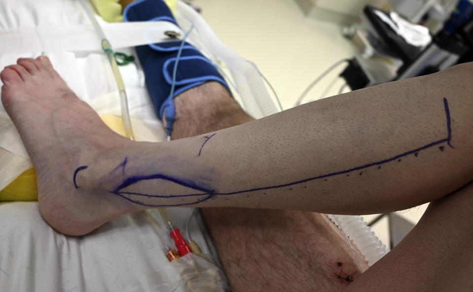 In this undated image provided by University of Utah Health, shows markings for preoperative planning on where to make incisions on Rudy Noorlander's leg for his free flap surgery in Salt Lake City. Noorlander was attacked by a grizzly bear on Sept. 8, 2023, south of Big Sky, Mont. After emergency surgery in Bozeman, Noorlander was flown to the University of Utah Hospital where he has continued his care. (University of Utah Health via AP)