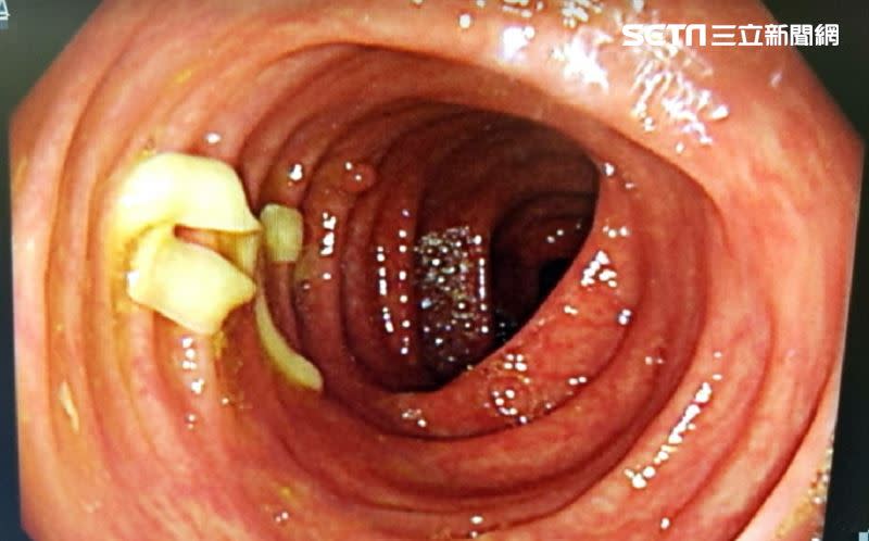 醫師在男子的腸道上發現絛蟲。（圖／蕭慕琦醫師授權提供）