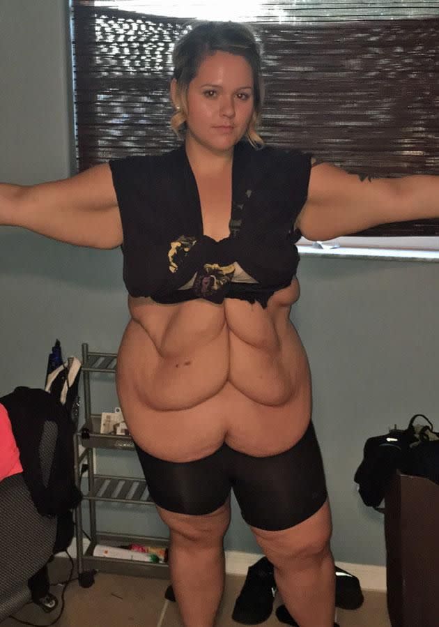 Kylie has had more than 17kgs of excess skin removed. Source: Caters News