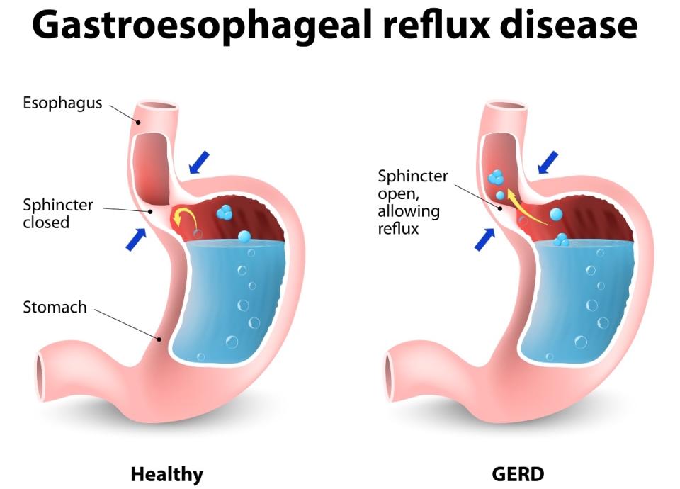 Heartburn, or GERD, flaring up at night