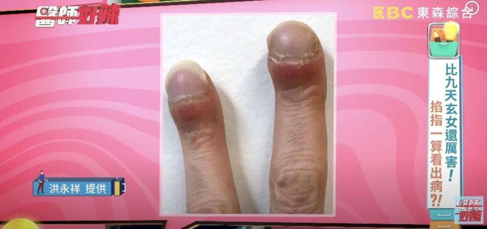 洪永祥醫師發現婦人有杵狀指，進一步檢查出罹患肺腺癌。（圖／翻攝自《醫師好辣》Youtube）