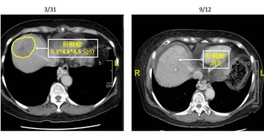 70歲吳女士為B肝患者，檢查發現肝部長有5公分大的腫瘤，採用立體放射手術合併雷沙瓦治療後，腫瘤目前已經消失。（圖／亞東醫院提供）