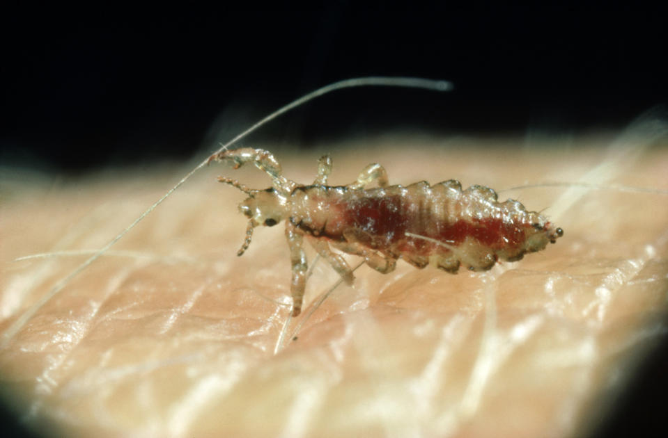 A close-up photo of a head louse [Photo: Getty]