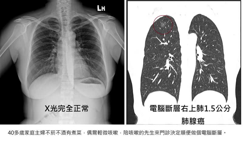 胸腔重症醫師蘇一峰在部落格以及臉書分享真實案例提醒，千萬不要以為胸部X光正常就等於沒有肺癌！（圖／蘇一峰醫師提供）