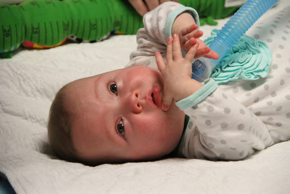 Doctors had to administer caffeine to this baby girl, born prematurely, to help her survive.