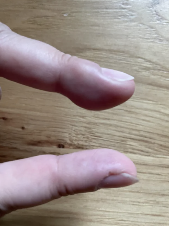 A swollen finger