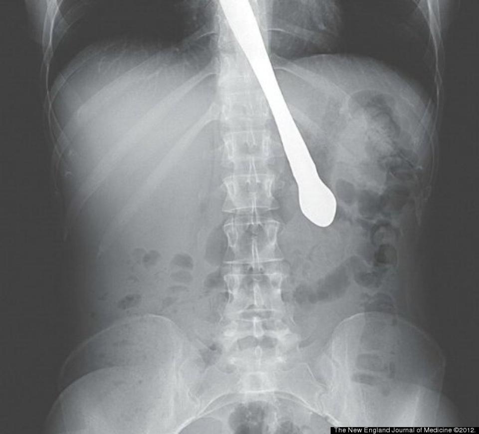 A 30-year-old Atlanta woman with a history of bulimia swallowed a knife while demonstrating that she no longer had a gag reflex for friends, according to the New England Journal of Medicine.