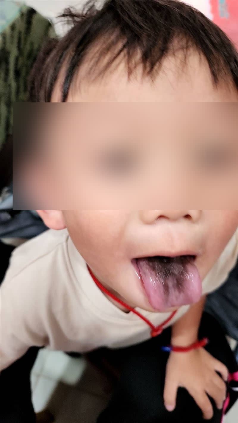 男童出現「黑毛舌」症狀，外觀看起來有點嚇人，但不會疼痛，經治療可完全治癒。(圖／光田醫院提供)