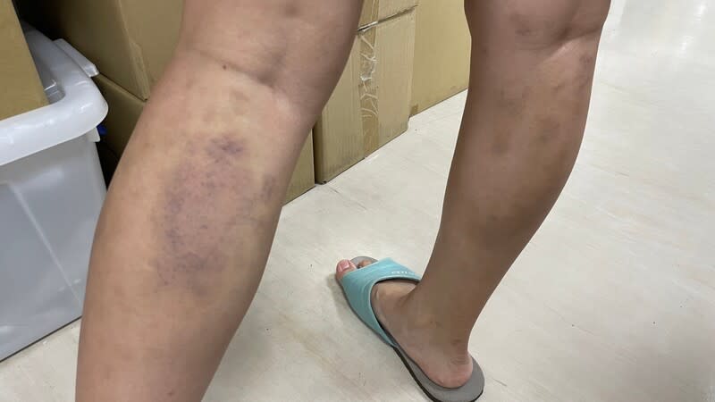 近日有民眾體驗撥筋療法後，小腿出現像被家暴的大範圍瘀青。（圖／中央社）