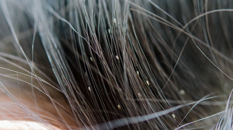 Lice and nits look like sesame seeds in your child's hair.