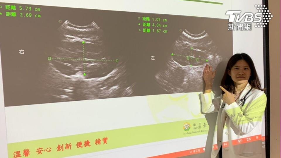 男嬰的腎臟超音波顯示雙側輕微水腎。（圖／TVBS）
