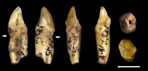<span class="caption">Teeth fossils with evidence of dental lesions from _Australopithecus africanus_.</span> <span class="attribution"><span class="source">Ian Towle</span>, <span class="license">Author provided</span></span>