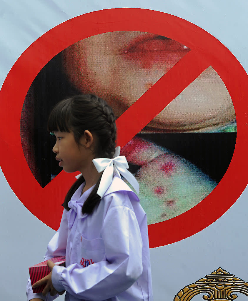 Student in front of a poster displaying anti hand, foot and mouth disease (HMFD) symptoms. Source: Getty