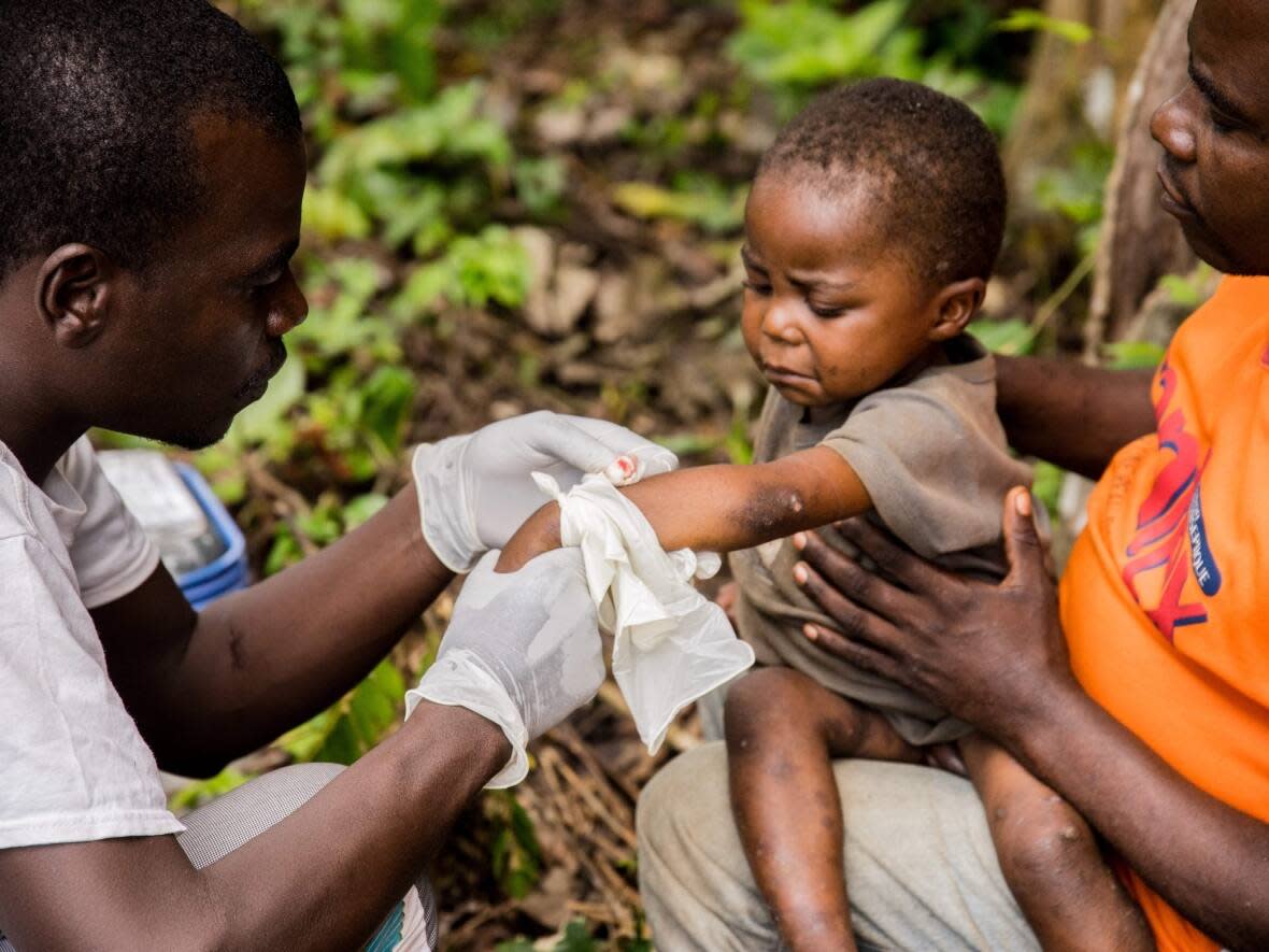 A child affected by mpox sits on his father's legs while receiving treatment at the centre of the International medical NGO Doctors Without Borders in the Central African Republic. The World Health Organization has declared an end to the global public health emergency for mpox, yet some scientists warn there's still cause for concern. (Charles Bouessel/AFP - image credit)