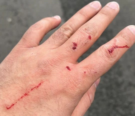 Muhammad Fahad's injured hand after two robbers raided Fone City store in St Albans, Hertfordshire on Sunday, 19 March 2023