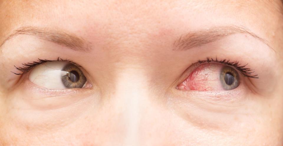 <p>Uveitis is inflammation of the middle layer of the eye that has blood vessels. This red irritation can signify a wealth <a href="https://www.womansday.com/health-fitness/a22487425/yeast-infection-symptoms-in-women/" rel="nofollow noopener" target="_blank" data-ylk="slk:of infections;elm:context_link;itc:0;sec:content-canvas" class="link ">of infections</a> and conditions, such as some sexually transmitted diseases like AIDS. According to <a href="https://www.webmd.com/eye-health/common-eye-problems#1" rel="nofollow noopener" target="_blank" data-ylk="slk:WebMD;elm:context_link;itc:0;sec:content-canvas" class="link ">WebMD</a>, those with AIDS may experience uveitis, as well as blurred vision, eye pain, redness, and light sensitivity.</p>