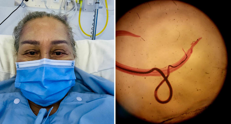 A photo of Queensland local Jocelyn, 70, in hospital in Brisbane. A photo of a parasitic worm causing Bilharzia under a microscope.