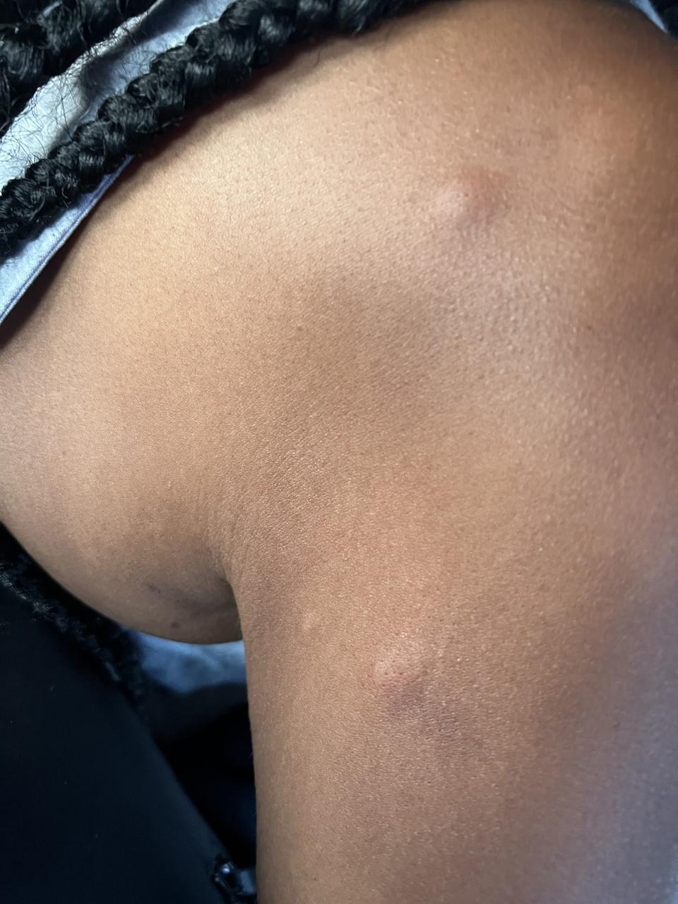 huge mosquito bites on an arm