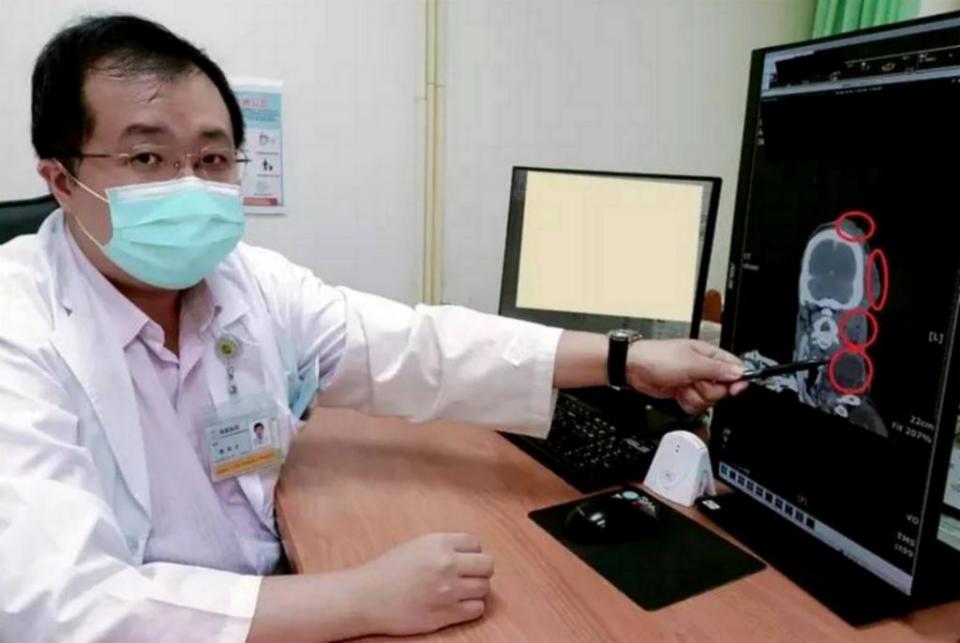 醫師陳筠方解說病患骨肉瘤病況，圈選處為腫瘤患部。（記者陳金龍攝）