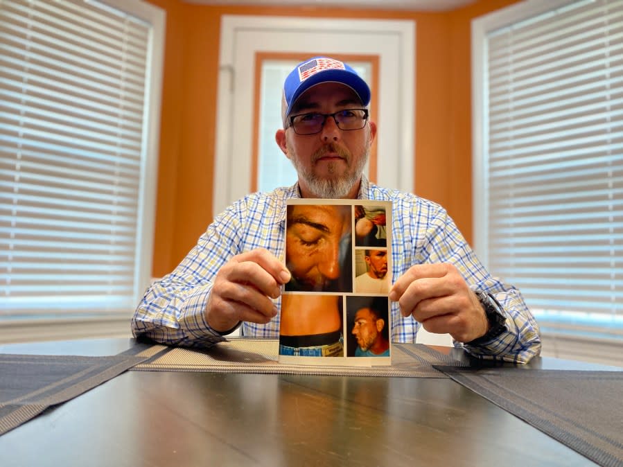 Shane Crowley shows photographs of injuries after he said his estranged wife attacked him alongside a Marlboro County highway in July 2021. Crowley says his attorney and his estranged wife’s attorney used the criminal charge as ‘leverage’ against him in the divorce settlement. (WJZY Photo/Jody Barr)