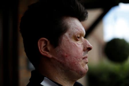 Acid attack victim Andreas Christopheros, poses for a photograph in his home in Truro, south-west England, Britain July 31, 2017. REUTERS/Peter Nicholls