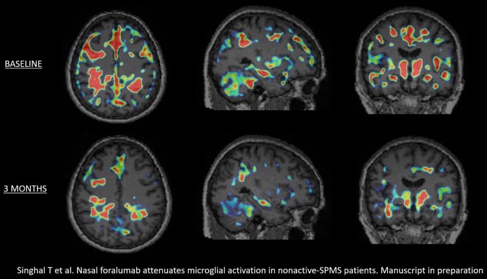 Baseline versus 3-month PET scans