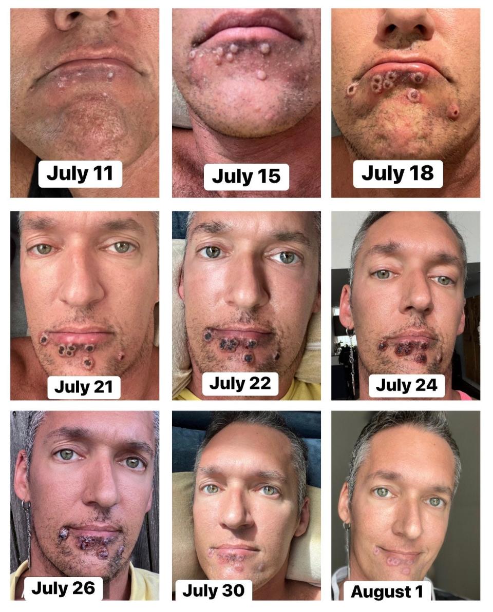 A collage of pictures shows what Steele's lesions looked like day by day