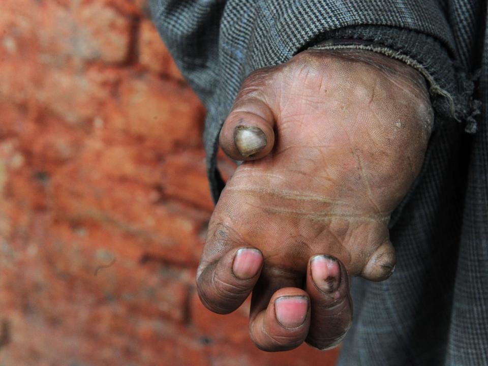 A leprosy patient at a leprosy hospital in India in 2017.