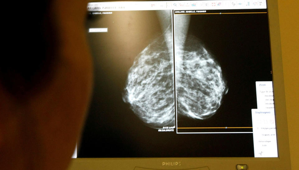 In women, breast cancer was the leading cause of cancer death.. Source: Reuters