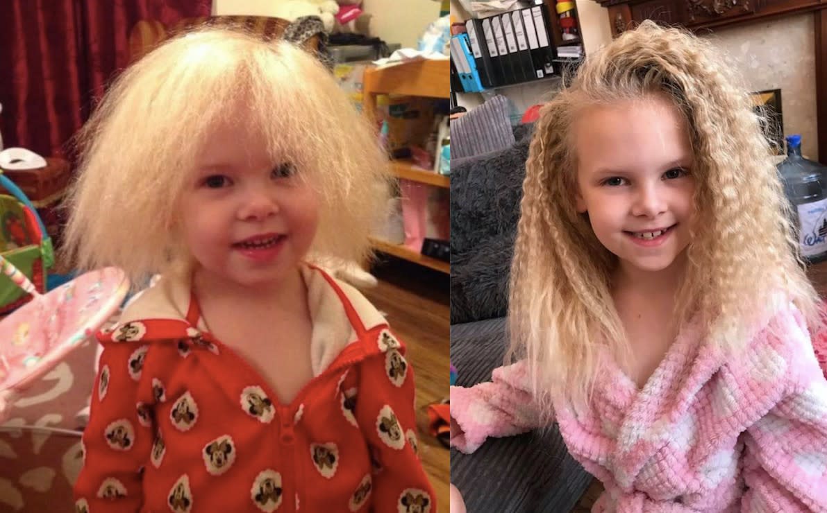 A little girl who suffers from uncombable hair syndrome is finally able to have her hair tamed after nine years. (Caters)