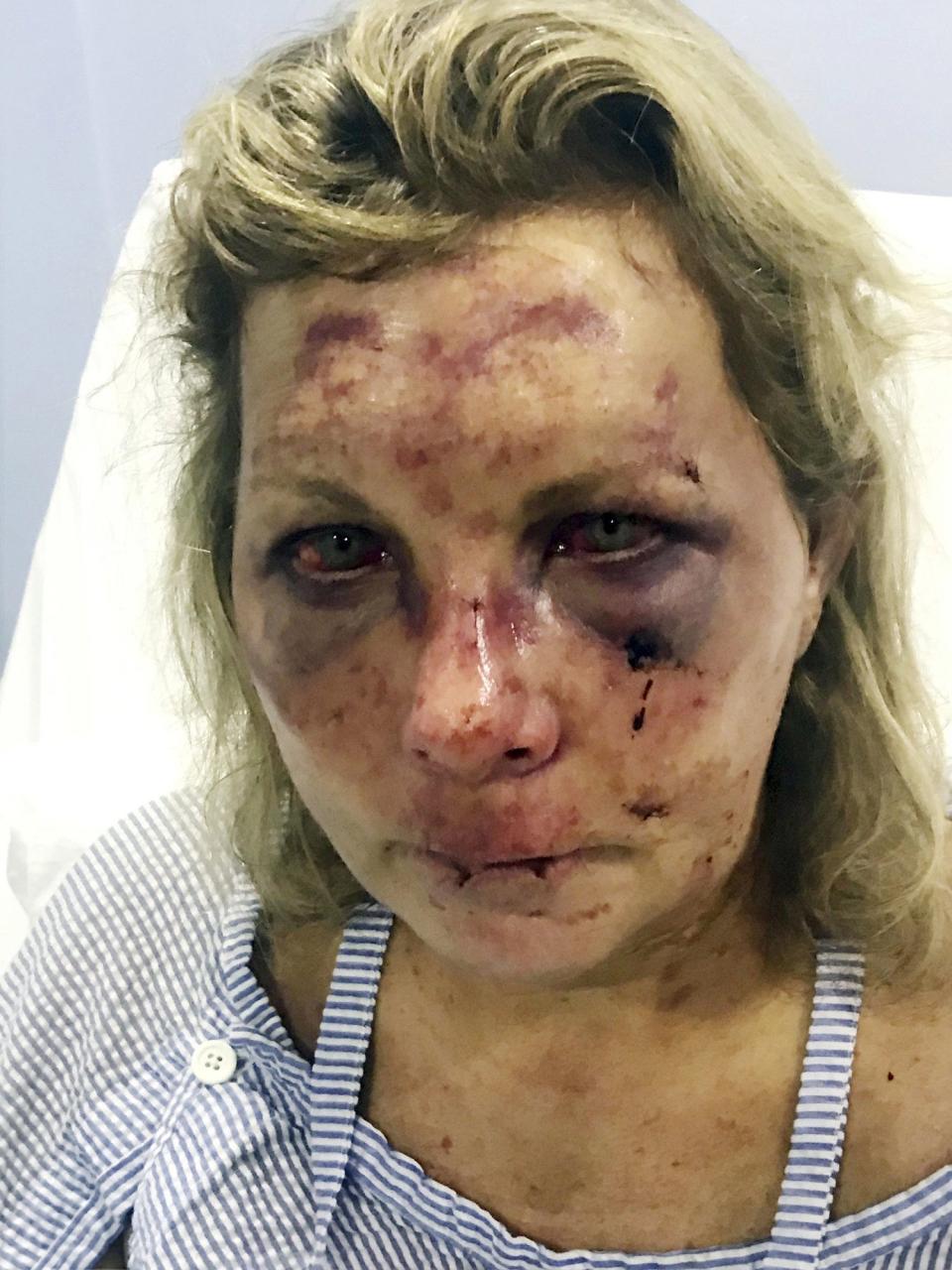 In this undated photo made available by Chris Daley, shows his wife Tammy Lawrence-Daley after an attack at a resort in Punta Cana, Dominican Republic in January 2019.