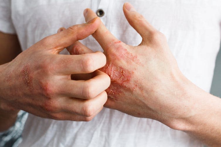 <span class="caption">Skin conditions like eczema that break the surface of the skin are often associated with food allergies.</span> <span class="attribution"><a class="link " href="https://www.shutterstock.com/download/confirm/580580401?size=medium_jpg&src=lb-59856941&sort=newestFirst&offset=3" rel="nofollow noopener" target="_blank" data-ylk="slk:Shutterstock;elm:context_link;itc:0;sec:content-canvas">Shutterstock</a></span>