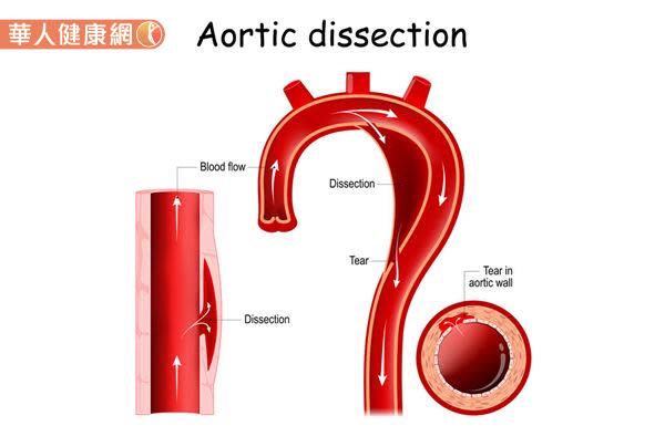 防主動脈剝離猝死！除了多囊腎、馬凡氏症患者應當心，更要小心無控制的高血壓