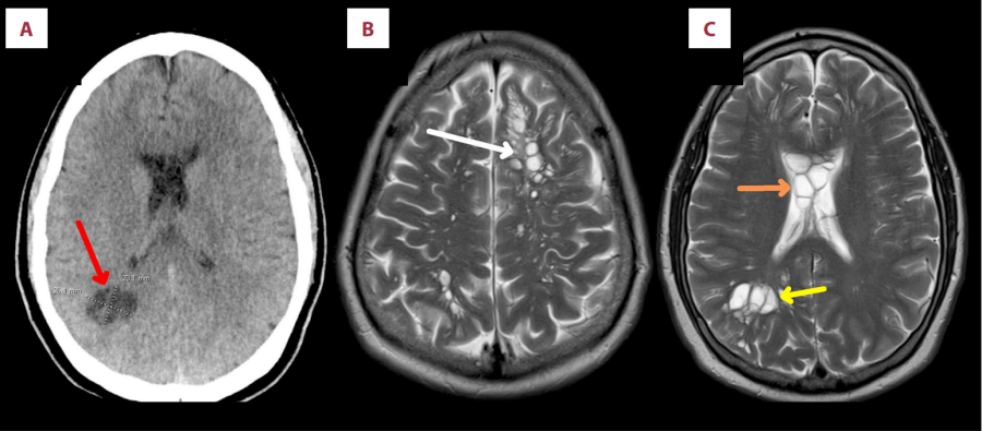 According to the study: “<em>CT head showed a cluster adjacent to the occipital horn of the right lateral ventricle, which measured maximally 2.6×2.3 cm across (red arrow). (B) MRI brain showed multilocular cystic lesions within the frontal and parietal cortices (white arrow). (C) Cystic lesions seen in the corpus callosum (orange arrow) and occipital lobe (yellow arrow).</em>“