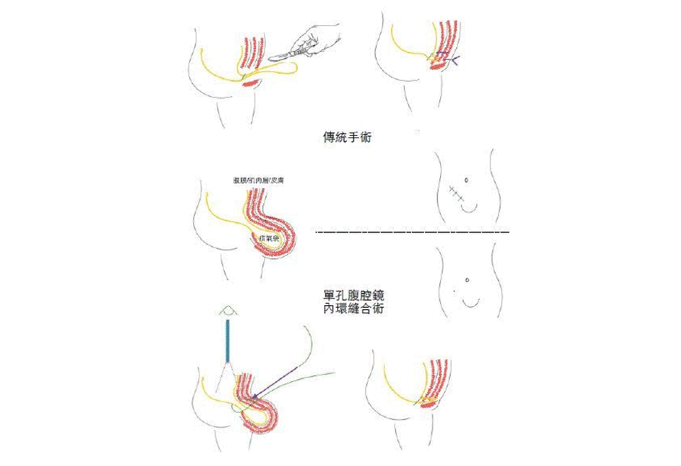 胯下腫脹隆起…疝氣作怪，新手術不留疤！