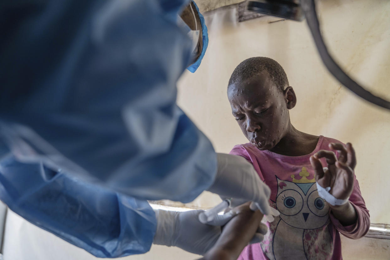 FILE - A health worker attends to a mpox patient, at a treatment centre in Munigi, eastern Congo, Aug. 19, 2024. (AP Photo/Moses Sawasawa, File)