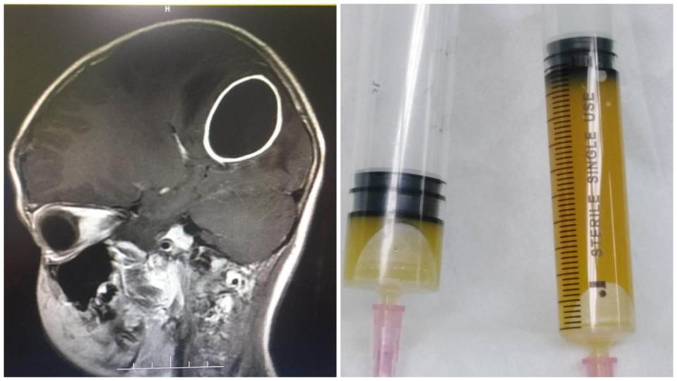 廣東一名8歲女童因為蛀牙拖了1年遲遲未治療，結果細菌侵襲腦部出現腦膿腫。（合成圖／翻攝自陸網）