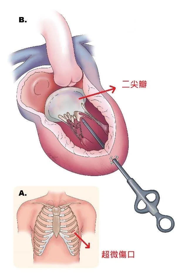 <strong>超微二尖瓣人工鍵索植入術 (A) 左胸超微傷口 (B) 人工鍵索植入。（圖／林口長庚醫院提供)</strong>