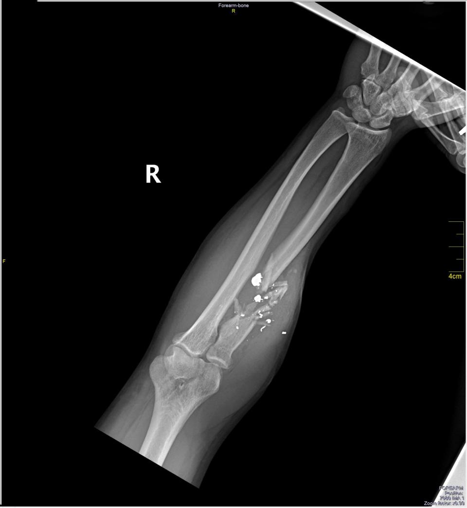 An X-ray image of an arm showing a fragmented bone and bullet shrapnel