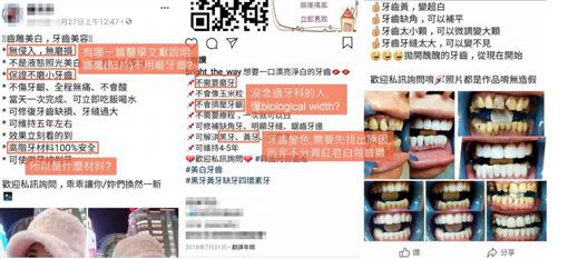 坊間美齒業者打出低價、不傷牙、高科技等話術，但經不起專業牙醫的檢視。（圖／牙醫林葳提供）