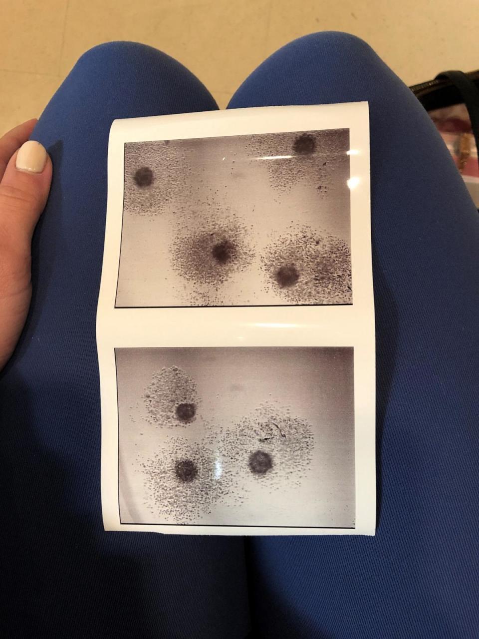 PHOTO: Harper-Grace Niedermeyer froze her embryos in Alabama after being diagnosed with breast cancer in her late 20s. (Harper-Grace Neidermeyer)