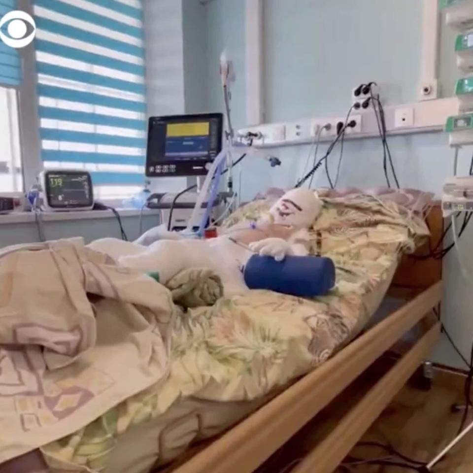 Seven-year-old Roman Oleksiv recovers in hospital after suffering burns on nearly half his body from a Russian missile strike - CBS/CBS