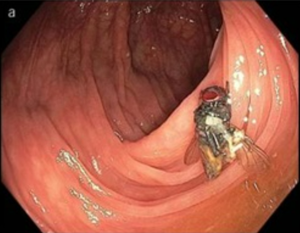 An unlikely visitor was found inside the man’s intestines  (American Journal of Gastroenterology)